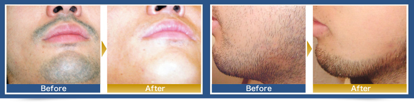 Male Facial Hair Removal Sale, 56% OFF 